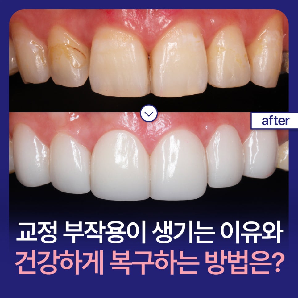 Why Do Orthodontic Side Effects Happen, and How Can You Recover Healthily? image 1