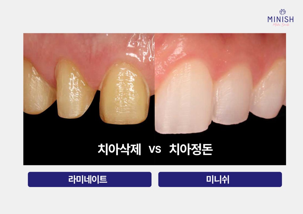 미니쉬와 라미네이트 차이점 총정리 관련 이미지 5
