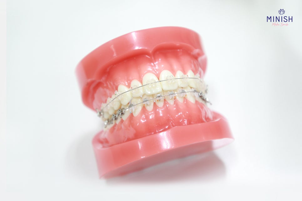 How to Restore Gapped Teeth Healthily in Just One Day image 3