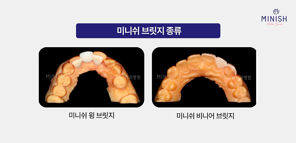 From Front Teeth to Molars, Which Minish Is Right for My Dental Condition? image 10