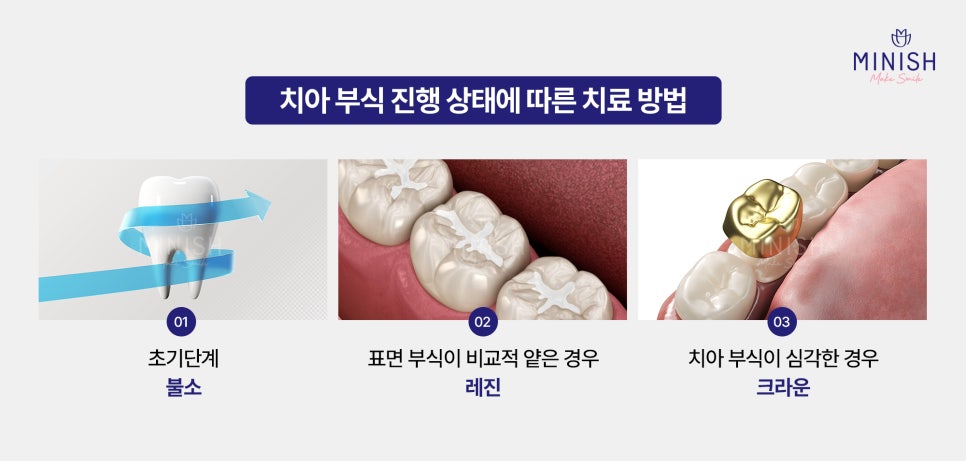 Tooth Erosion: If Left Untreated, It’s Hard to Recover! A Complete Guide to Treatment by Stage image 4