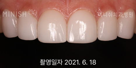 누런치아, 치아 미백으로 해결되지 않을 땐? 관련 이미지 11