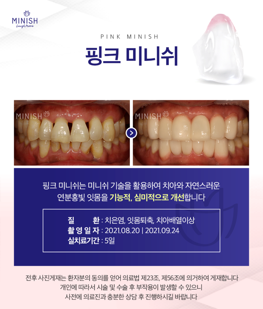 잇몸퇴축으로 치아가 길어보인다면? 청담동 치과 관련 이미지 5
