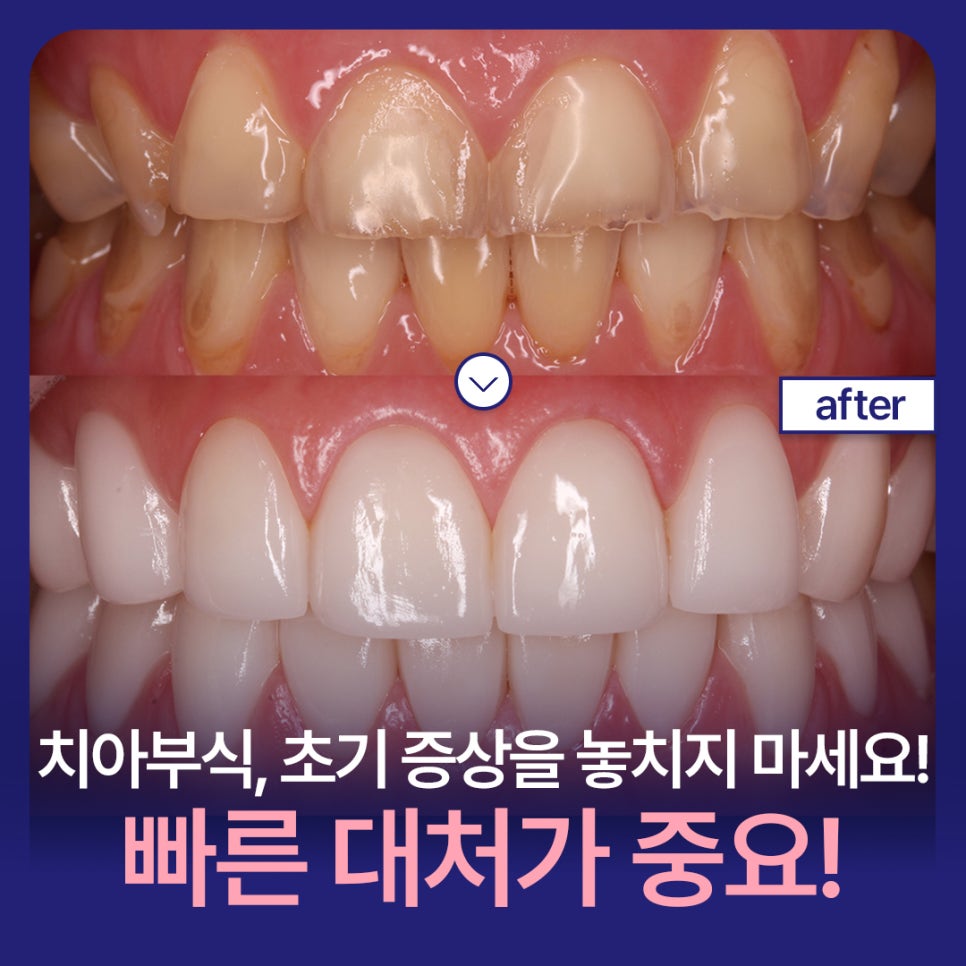Tooth Erosion: If Left Untreated, It Can Lead to Bigger Problems! Learn About the Causes and Treatment Options image 1