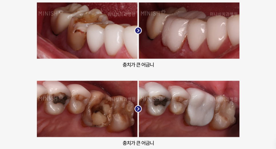 충치 근본 원인을 해결하는 미니쉬를 활용한 충치치료 관련 이미지 10