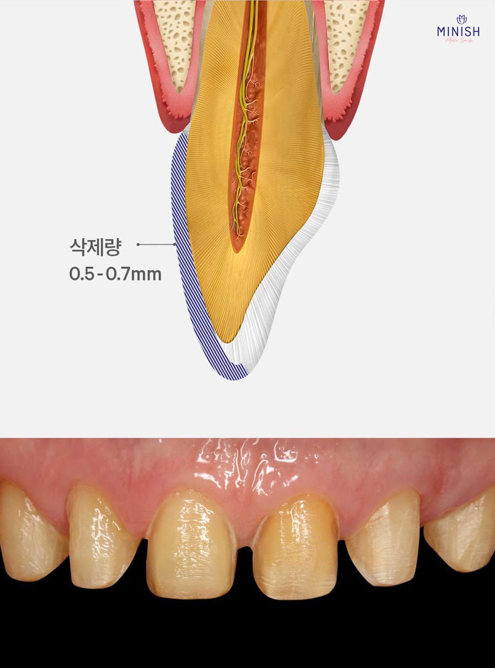 [연예인 라미네이트] 미니쉬치과병원을 유명 연예인들이 선택하는 이유는? 관련 이미지 4