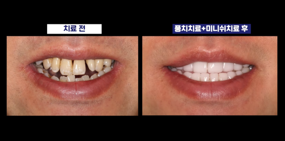 잇몸염증은 구강 적신호...가장 적극적인 잇몸치료는 미니쉬 관련 이미지 21