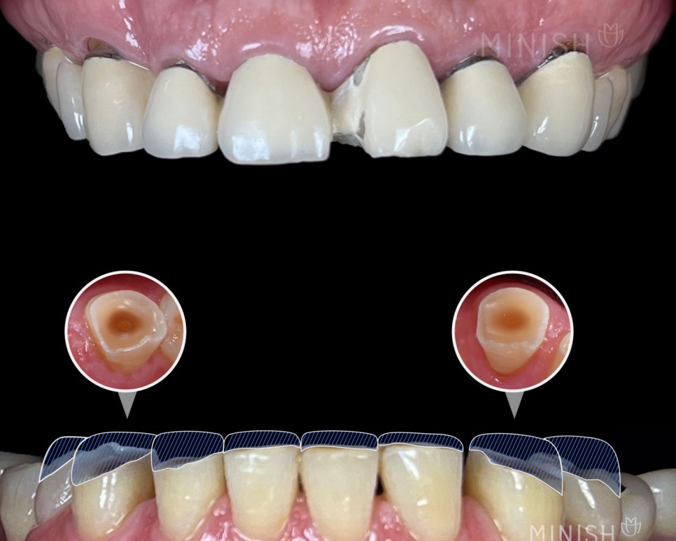The Difference Created by Technology: A Complete Comparison of Minish vs. Laminate image 11