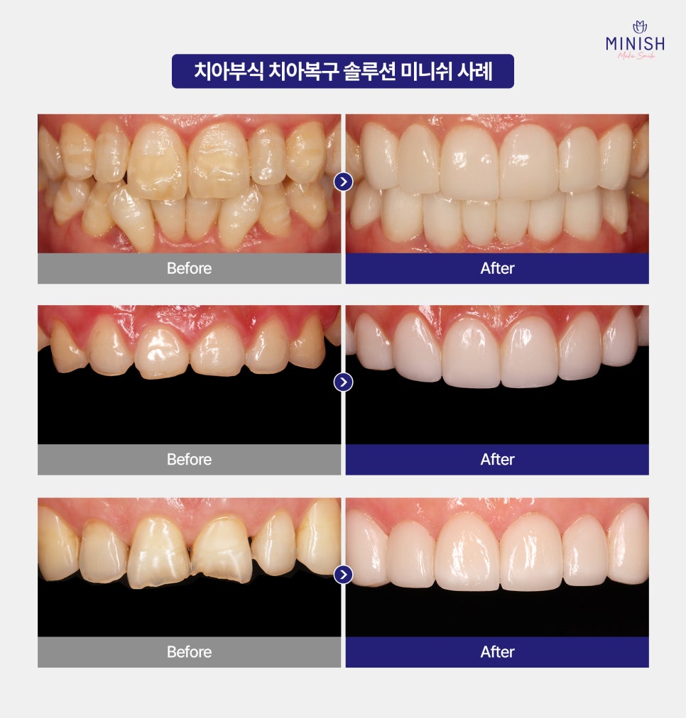 Tooth Erosion: If Left Untreated, It Can Lead to Bigger Problems! Learn About the Causes and Treatment Options image 6