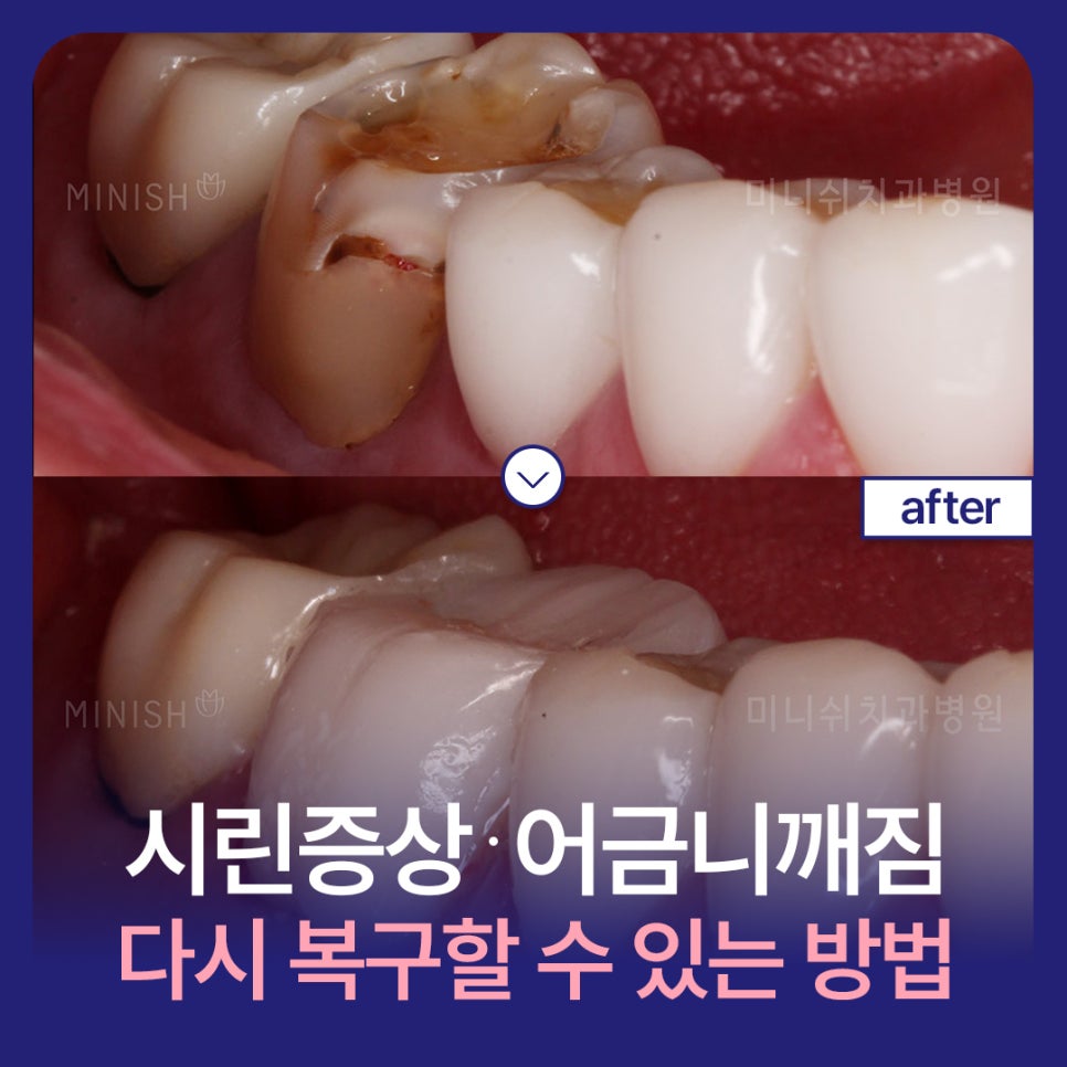 시린증상 어금니깨짐 다시 복구할 수 있는 방법 알려드려요 관련 이미지 1