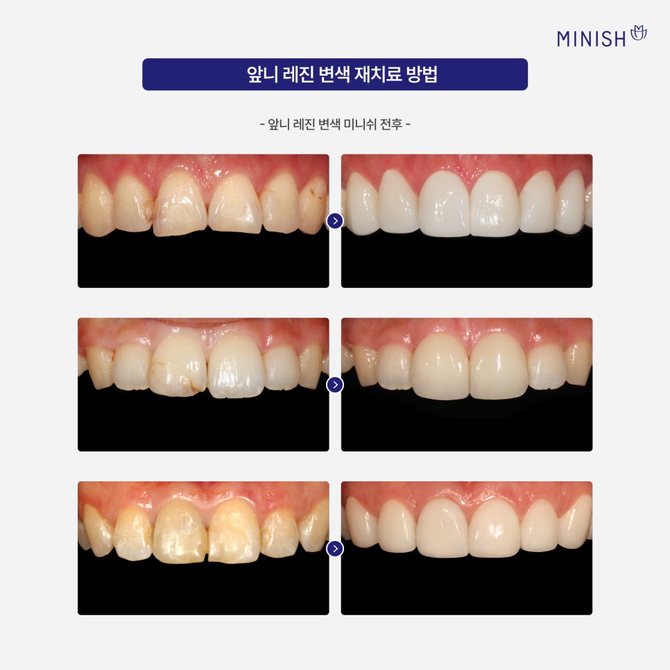 Understanding Discolored Resin on Front Teeth, from Causes to Retreatment image 7