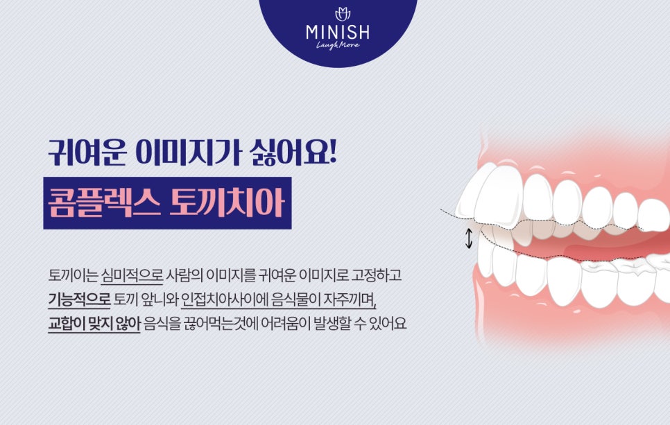 도드라지는 토끼치아 콤플렉스 미니쉬치과병원에서 앞니교정으로! 관련 이미지 4