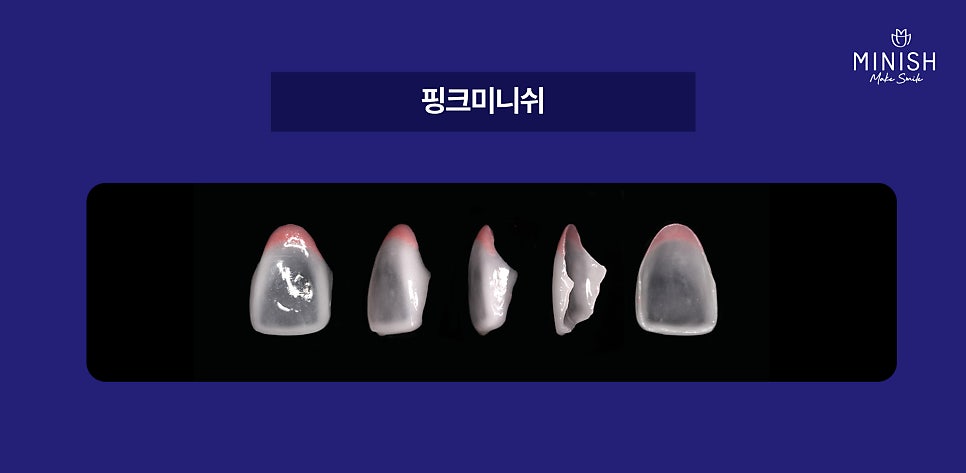 Relieve Tooth Sensitivity Caused by Cervical Abrasion with Pink Minishe image 6
