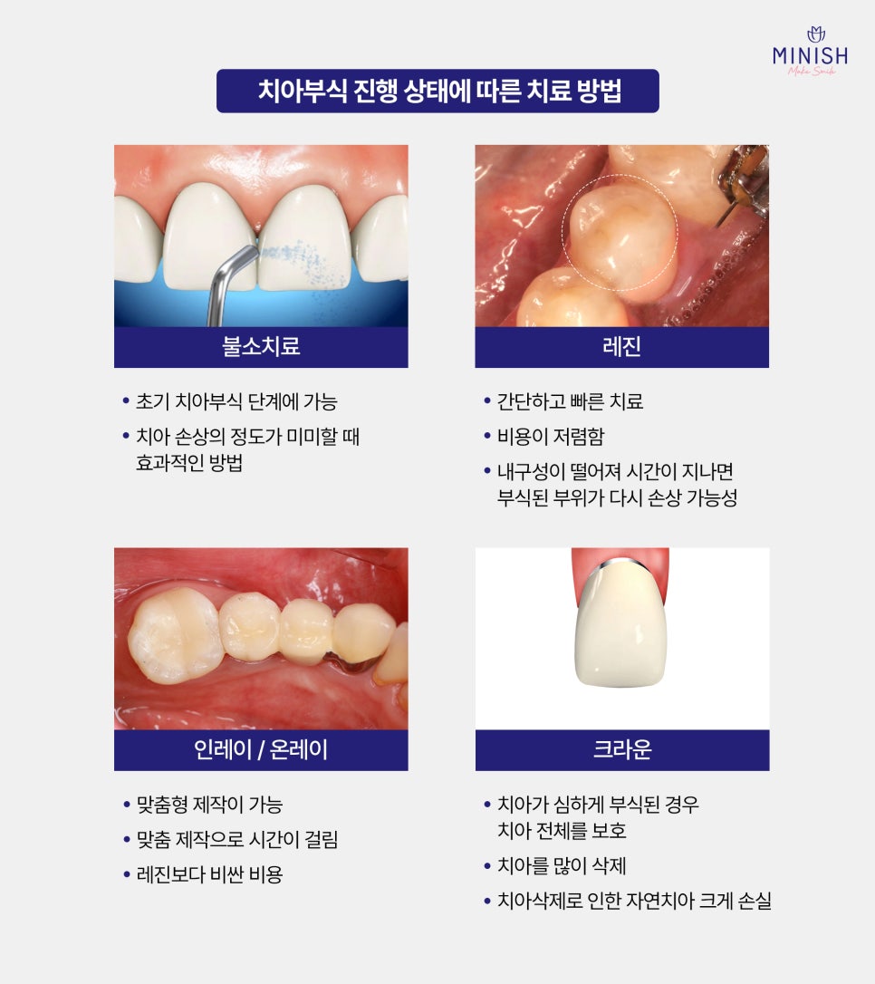 Tooth Erosion: If Left Untreated, It Can Lead to Bigger Problems! Learn About the Causes and Treatment Options image 4