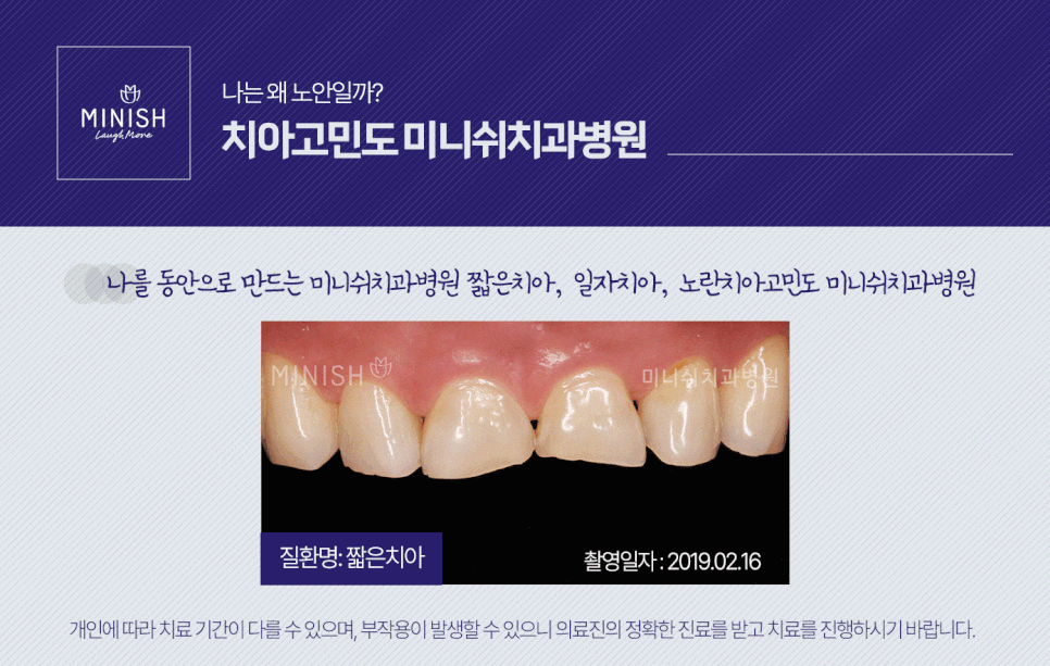 누렇고 짧은치아 개선법 관련 이미지 7