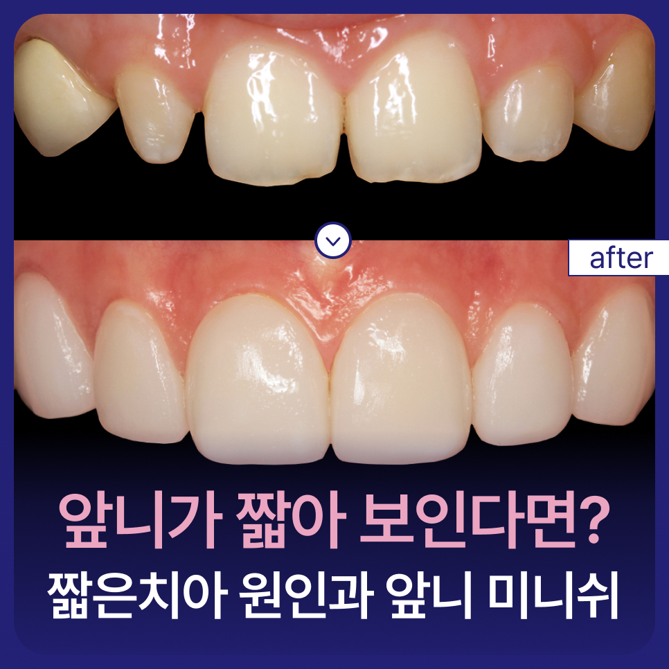 앞니가 짧아 보인다면? 짧은치아 원인과 앞니 미니쉬 관련 이미지 1