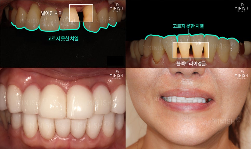 Are you wondering how to restore gums damaged by gum disease? image 7
