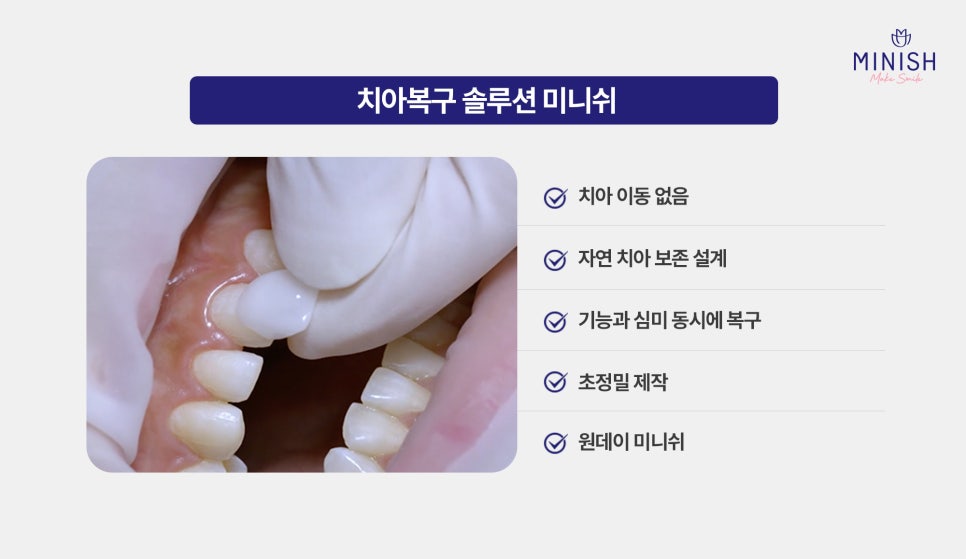 Worried About Gaps Between Your Teeth? Solve It Quickly with Minish While Protecting Your Natural Teeth! image 5