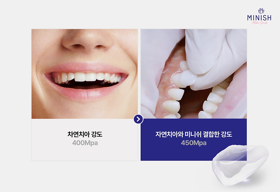 치아보존치료의 새로운 기준은 ‘미니쉬‘ 관련 이미지 3