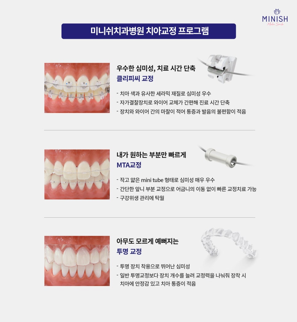 A Complete Guide to Adult Orthodontic Types: Which Method Is Right for Me? image 3