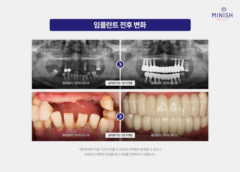 65세이상 임플란트 보험 적용 나이 기준과 주의사항 알아보기 관련 이미지 5