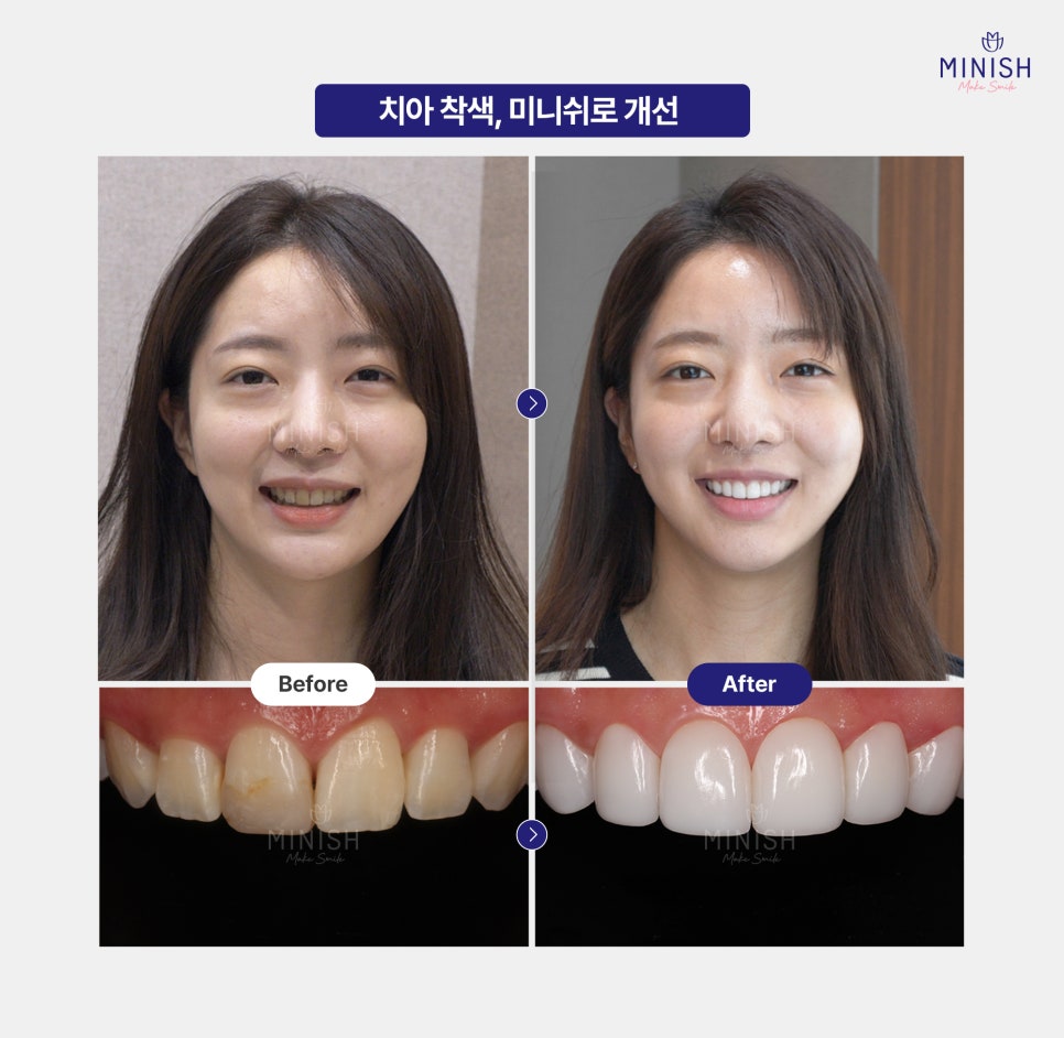 치아 착색 미백, 미니쉬 다양한 치료 방법과 예방법 관련 이미지 9