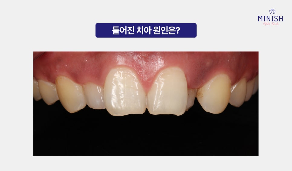 Why You Shouldn’t Leave Crooked Teeth Untreated? A Way to Improve Them in Just One Day! image 2