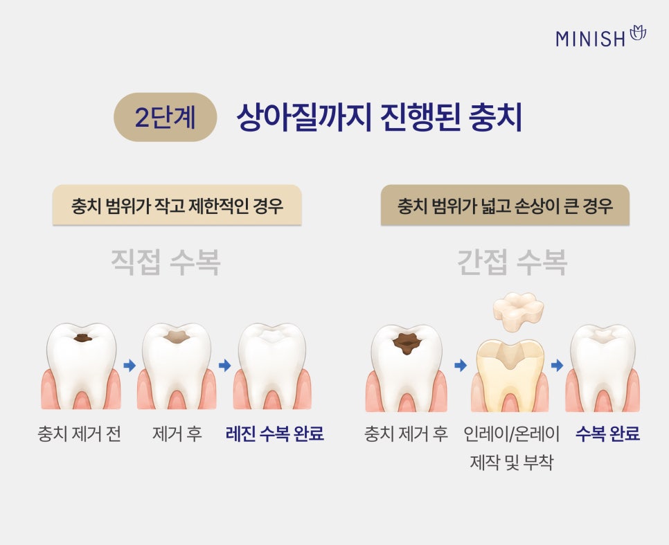 충치 단계별 치료 방법, 원데이 치료로 하루 만에 가능할까? 관련 이미지 4