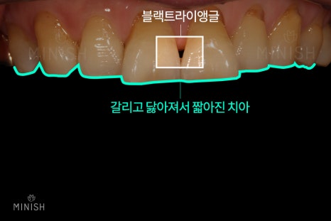 경기도엄마, 치아노화를 극복하다 [엄마는예뻤다] 관련 이미지 9