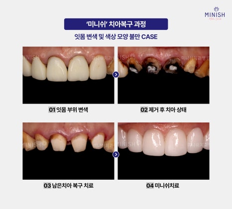 When Crown Retreatment Is Needed: The Tooth Restoration Solution Minish image 8