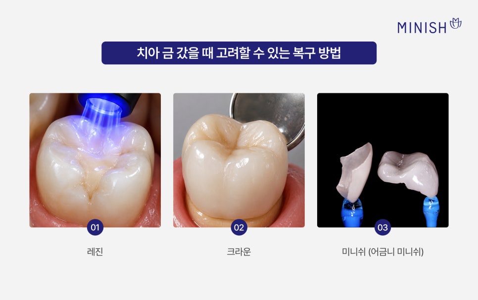 Problems That Can Occur If a Cracked Tooth Is Left Untreated and Ways to Preserve Natural Teeth image 6