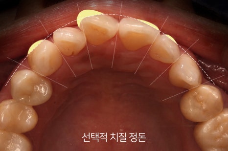 Is It Possible to Straighten Teeth in Just One Day? image 13