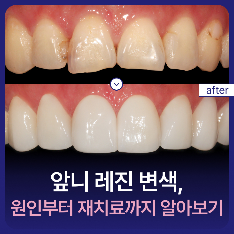 Understanding Discolored Resin on Front Teeth, from Causes to Retreatment image 1