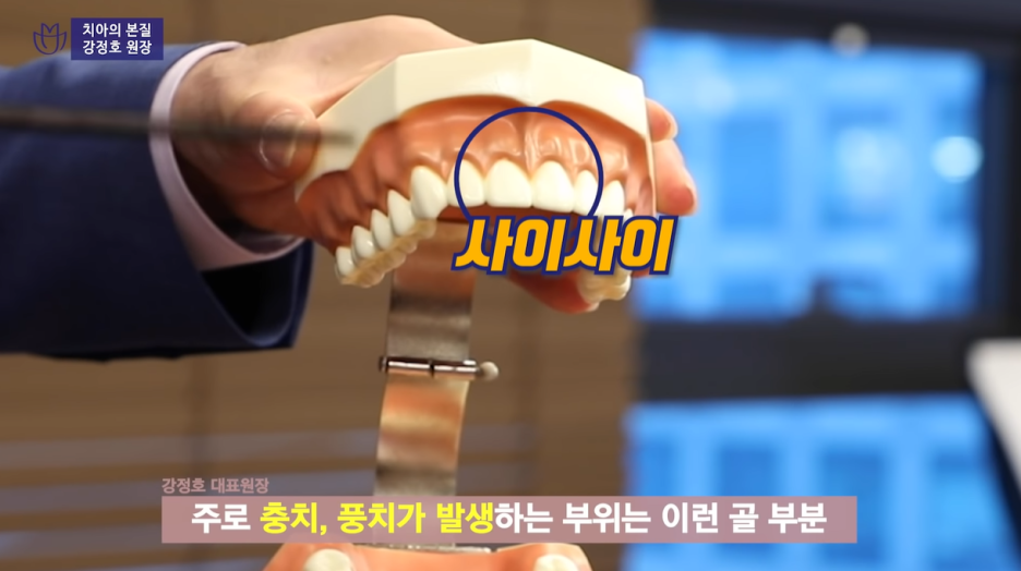 잇몸염증은 구강 적신호...가장 적극적인 잇몸치료는 미니쉬 관련 이미지 23