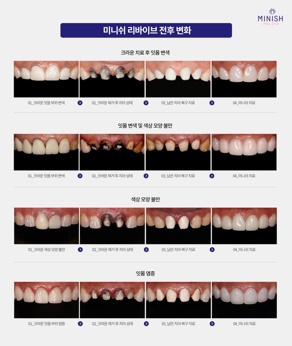 Should a Discolored Front Tooth Crown Be Replaced? Minish Revive for Retreatment image 6