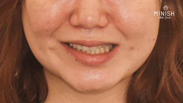벌어진 치아로 잃어버린 자신감, 미니쉬로 되찾다 관련 이미지 4
