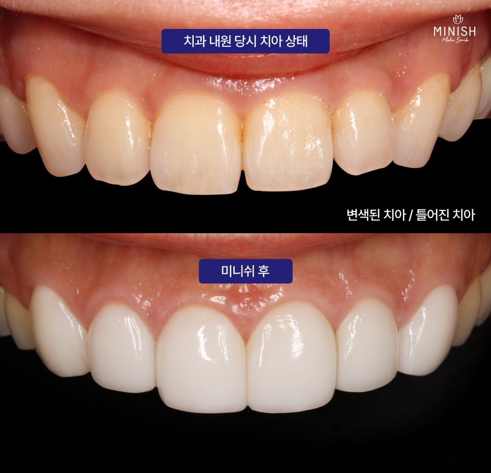 누런 치아? 치아변색 원인과 치료방법은? 관련 이미지 8