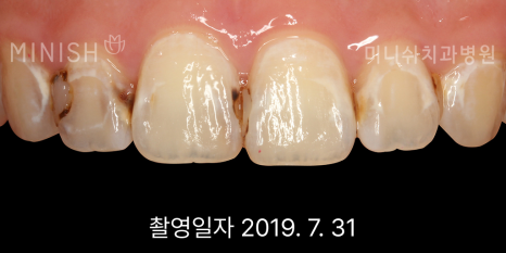 입냄새 원인 별 예방과 제거 치료 방법은? 관련 이미지 5