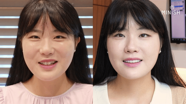 원데이라미네이트와 미니쉬 원데이 시스템 왜 다르고, 무엇이 나을까? 관련 이미지 8