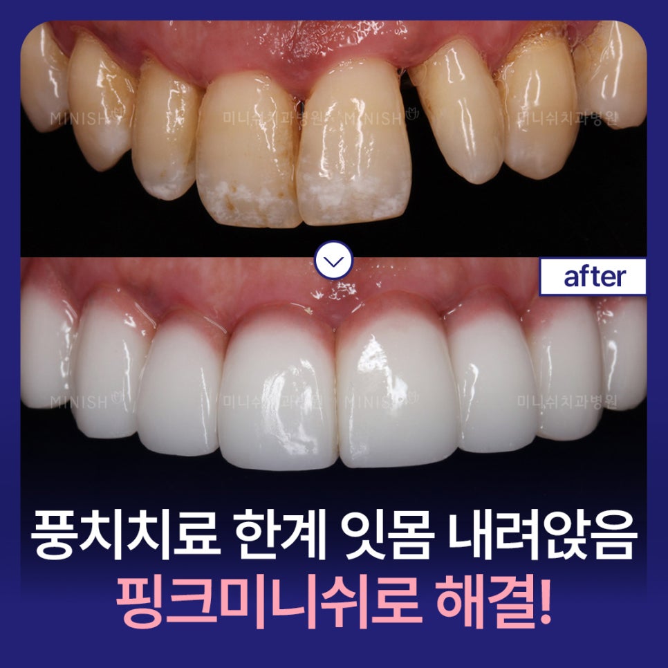 풍치치료 한계 잇몸내려앉음 핑크미니쉬로 해결! 관련 이미지 1