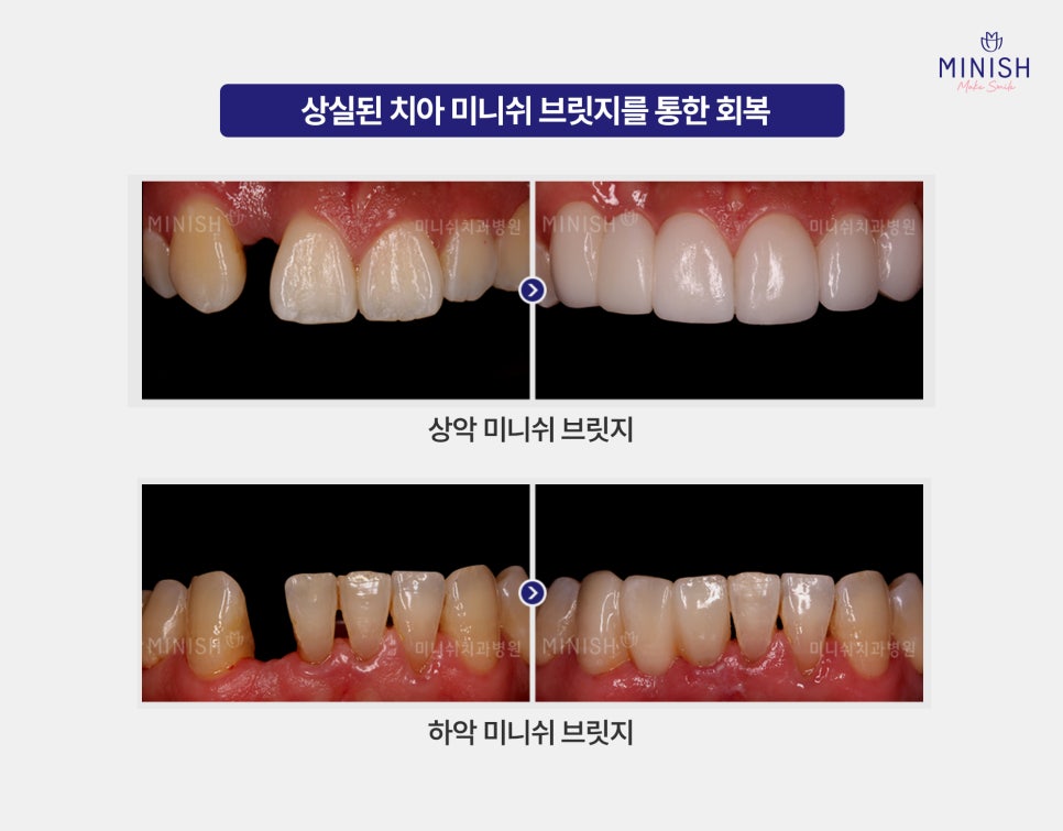 강남구청역치과 치아 흔들림 원인, 방치하면 생기는 변화 관련 이미지 6