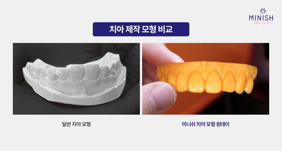 원데이라미네이트와 미니쉬 원데이 시스템 왜 다르고, 무엇이 나을까? 관련 이미지 4