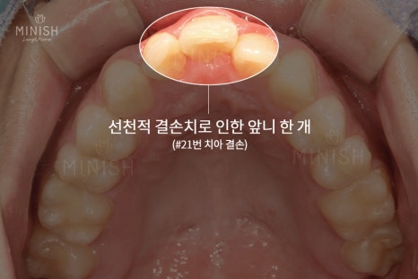 가평엄마 아들의 결손치, 미니쉬로 복원! [엄마는 예뻤다] 관련 이미지 12