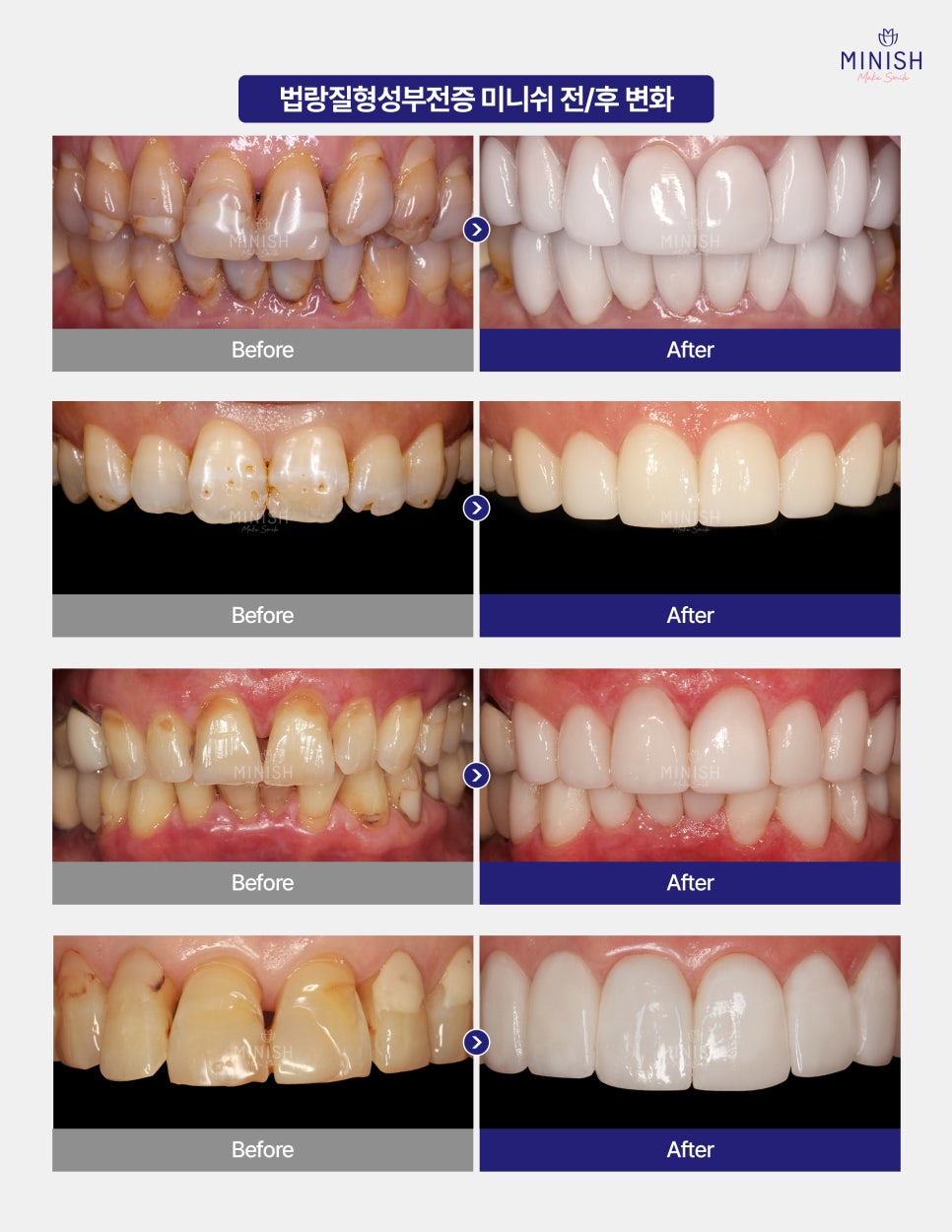 Rough, Speckled Tooth Surfaces? Enamel Hypoplasia image 6