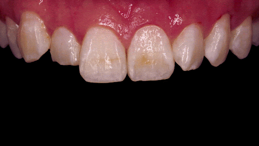 Gaps Between the Front Teeth After Orthodontic Treatment: Addressing Them with the Minish Line image 5