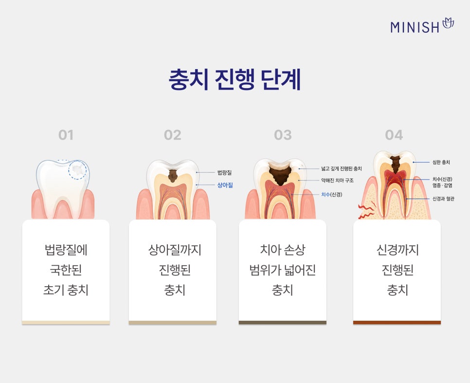 충치 단계별 치료 방법, 원데이 치료로 하루 만에 가능할까? 관련 이미지 2