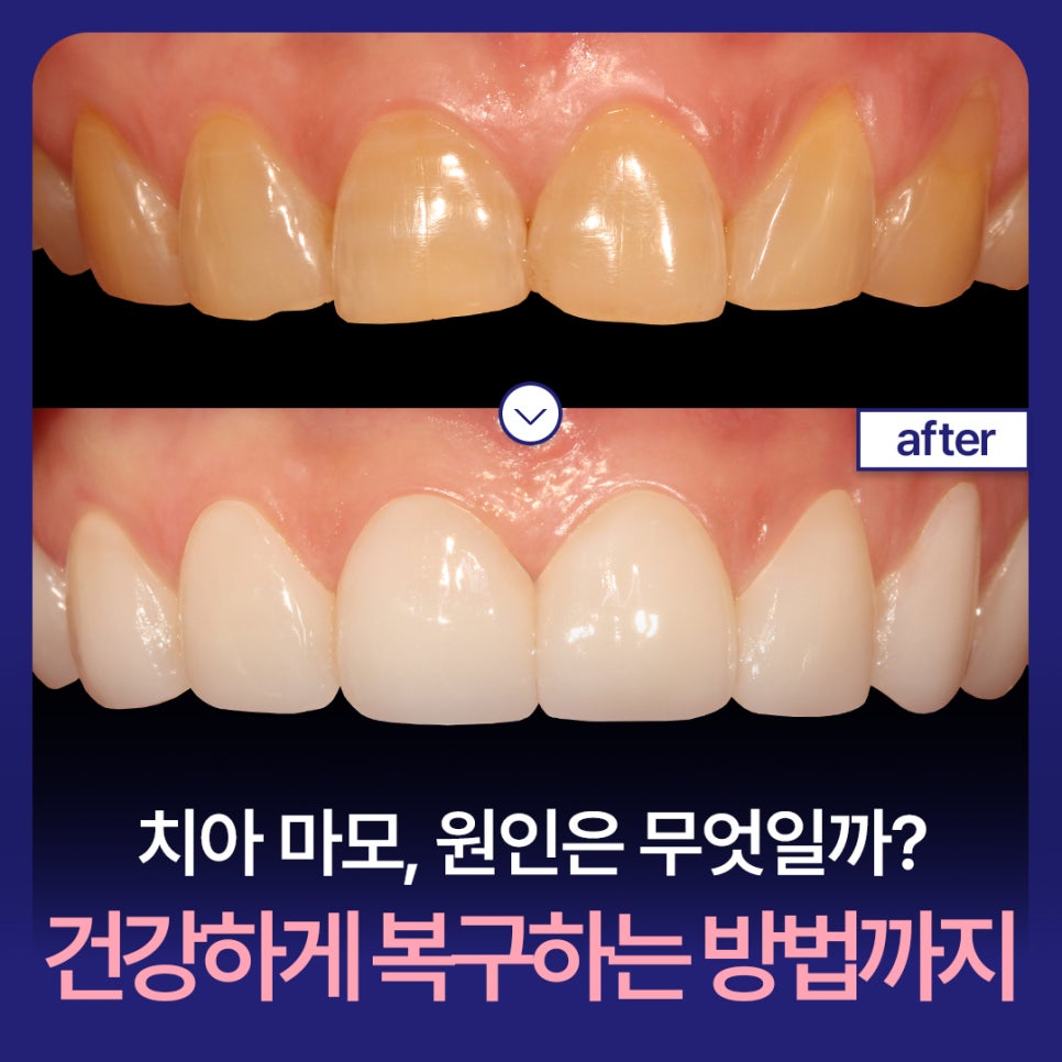 Tooth Wear: What Causes It? How to Restore Teeth Healthily image 1