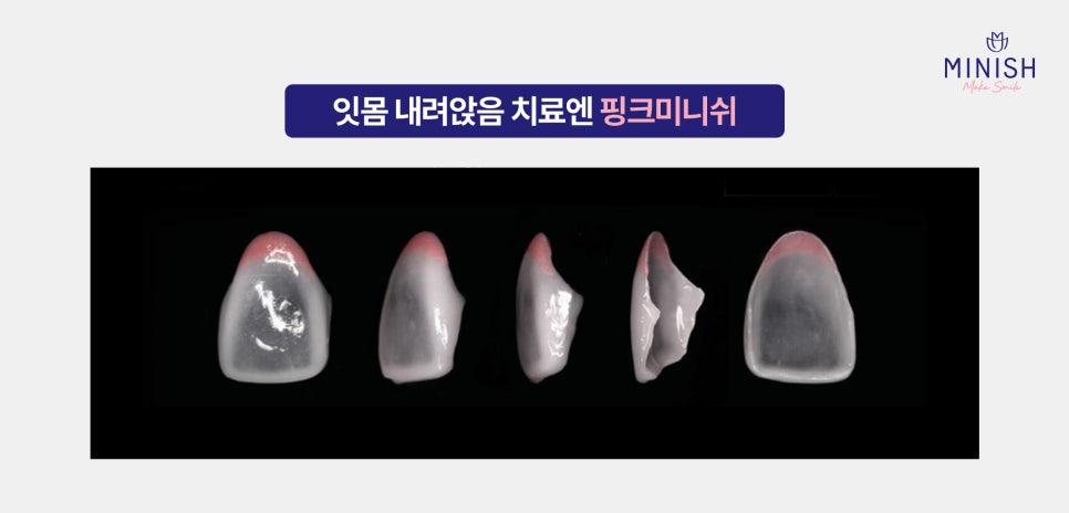 잇몸 내려앉음 치료 방법은? 원인과 증상까지! 관련 이미지 3