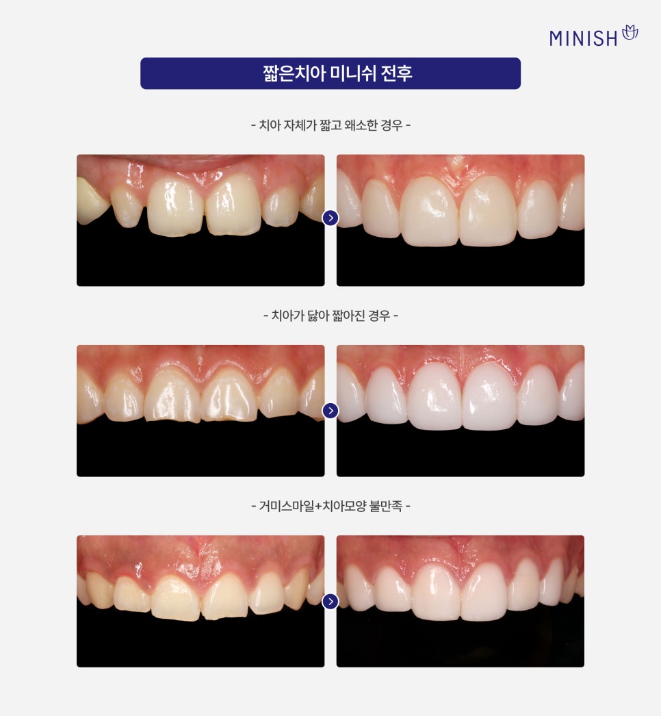 앞니가 짧아 보인다면? 짧은치아 원인과 앞니 미니쉬 관련 이미지 6