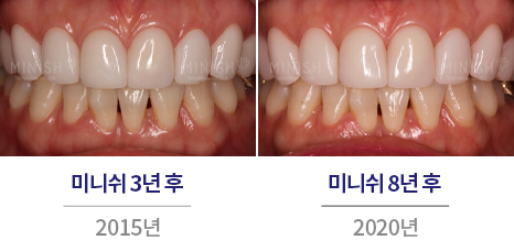 강남구치과 앞니깨짐 미니쉬로 해결한 후기 관련 이미지 7